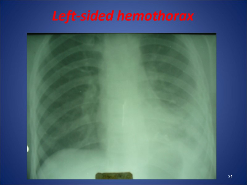 Left-sided hemothorax  24